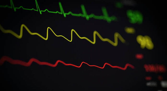 ecg